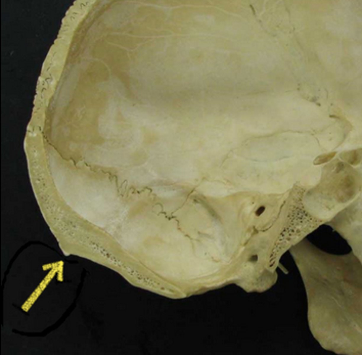 <p>most prominent projection of the occipital bone at the posterioinferior (lower rear) part of the skull</p>