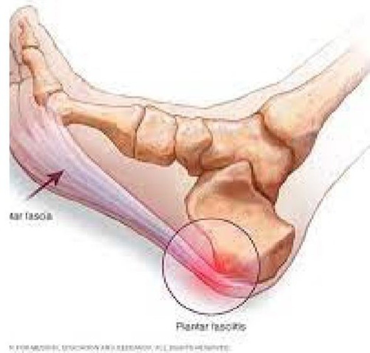 <p>Tough layer on the bottom of the foot becomes inflamed.</p>