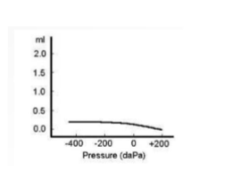 <p><span>patient with middle ear fluid</span></p><p><span>conductive hearing loss,big airbone gaps </span></p>
