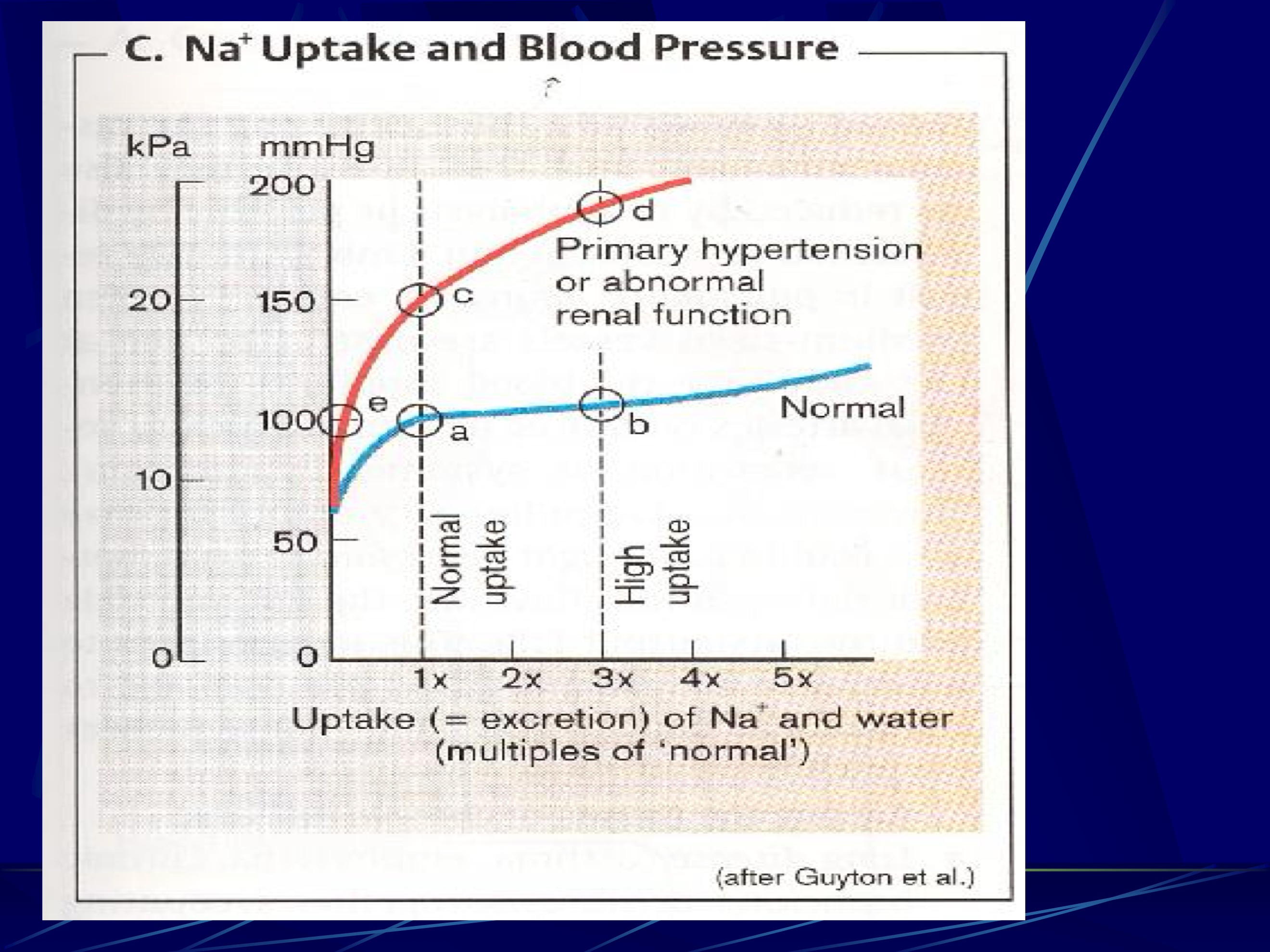 <p>Wzrost oporu przedkłębkowego spowodowany</p><p>skurczem naczyń vas afferens (miażdżyca,</p><p>pobudzenie współczulne) --> znoszą blokery</p><p>kanałów wapniowych</p><p>2. Zwiększenie kanalikowej reabsorpcji Na występuje w</p><p>nadciśnieniu sodozależnym i w nadprodukcji</p><p>mineralokortykoidów, Ang II</p><p>(Sodozależne: przyjmowanie soli)</p><p>3. Spadek współczynnika filtracji kłębuszkowej</p><p>(glomerular capillary filtration coefficient, Kf)</p><p>spowodowanym nawet niewielką dysfunkcją</p><p>błony podstawnej kłębuszków –</p><p>glomerulonephritis, kłębkowe zapalenie nerek</p><p>KZN</p><p>4. Zmniejszenie ilości funkcjonujących</p><p>nefronów.</p><p>Hiperfiltracja --> stwardnienie kłębuszków</p><p>(glomerulosclerosis) patomechanizm</p><p>postępującego uszkodzenia nerek PNN</p>