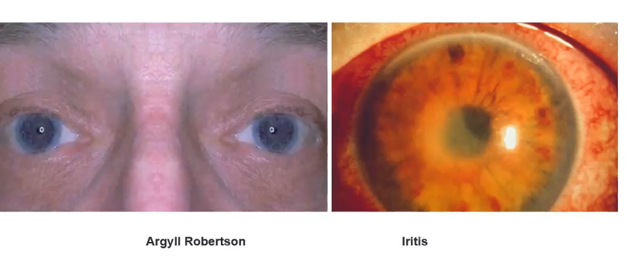 <p>argyl: pupils so not constrict to light but do when focusing on near objects </p><p>iritis : red eye , pain , constricted pupil , cells and flar in anterior chamber </p><p></p>