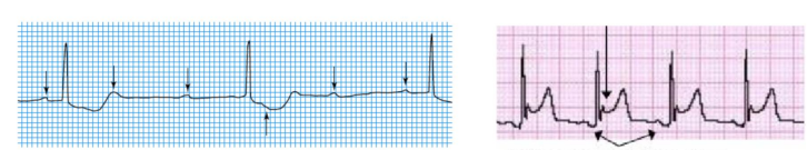 ST DEPRESSION & ELEVATION