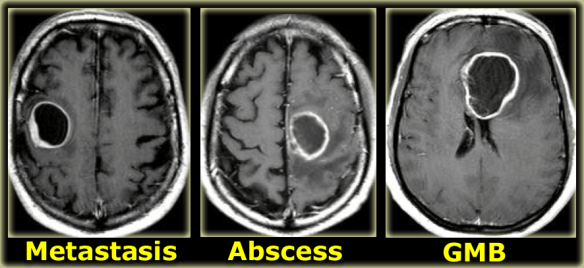 <p>Space Occupying Lesion - either a tumour, abscess or haematoma</p>
