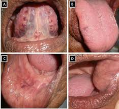 <p>small purple/black-blue swellings under tongue</p><p>due to age</p><p>no clinical significance</p>