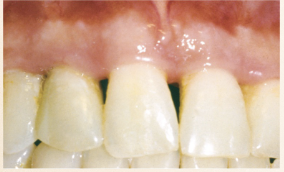 <p>Describe the tissue contour in this image?</p>