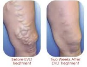 <p><span>In this image of patient pre and post endovascular ablation, is the vein medial or lateral leg?&nbsp;</span></p>