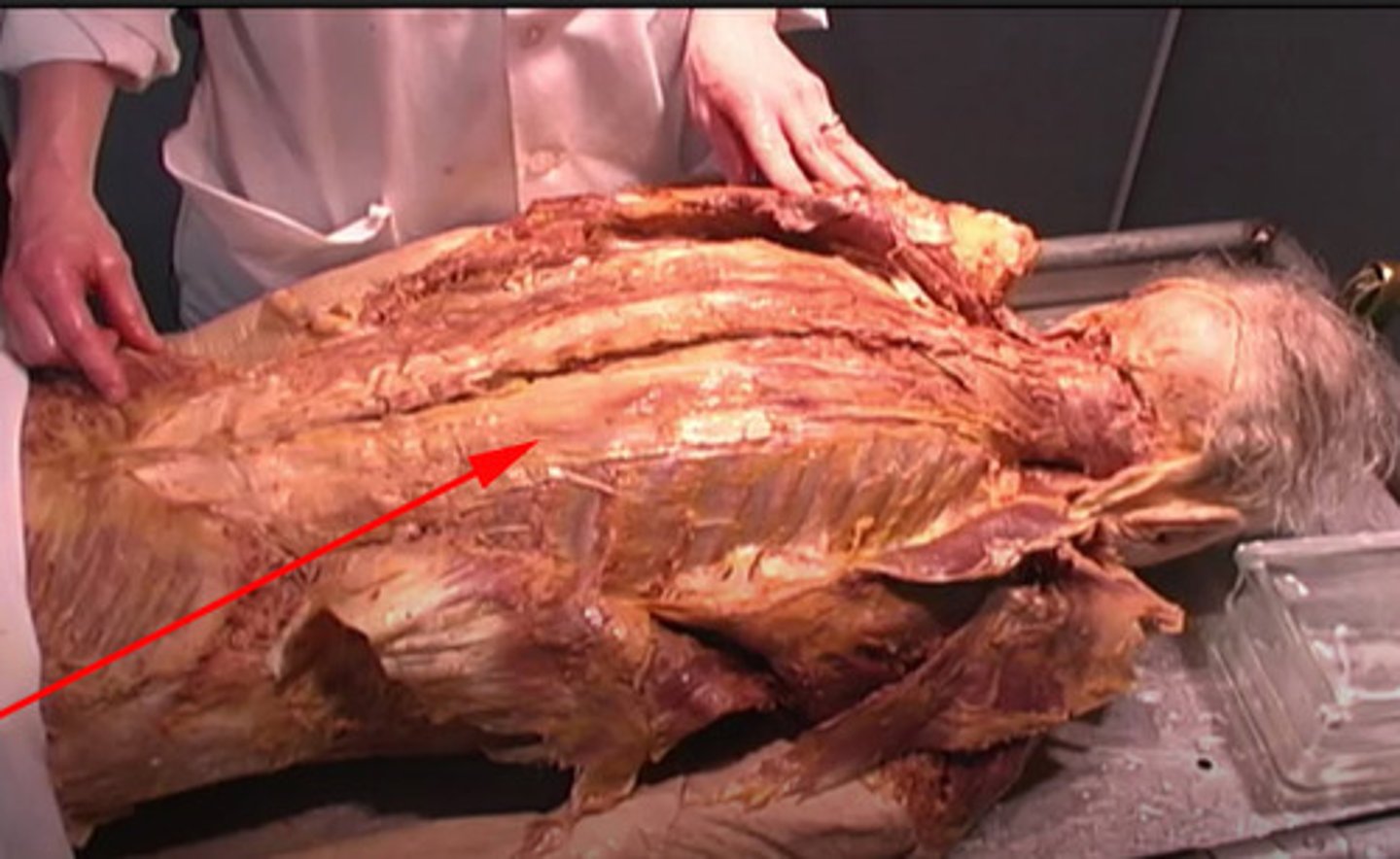 <p>To what structure is the red arrow pointing?</p><p>Intercostal</p><p>Spine</p><p>Erector Spinae</p><p>Latissimus dorsi</p>