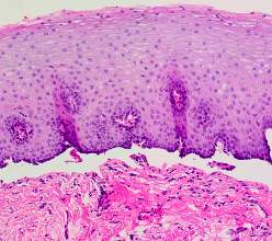 <p>separation of epidermis at the subepidermal interface</p>