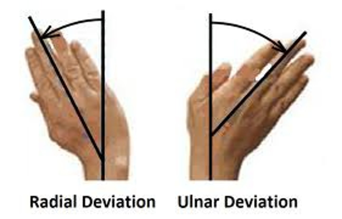 <p>wrist shifts outward to ulna and is a sign of rheumatoid arthritis</p>