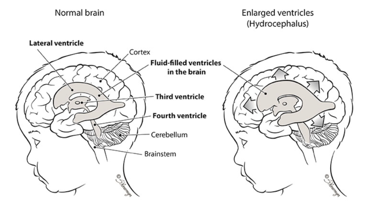 <p>A brain abnormality where there is excess fluid in the brain which puts harmful pressure on the brain’s tissues</p>