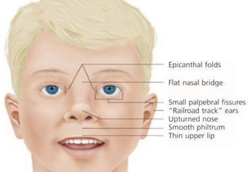 <p>Fetal Alcohol Syndrome (FAS)</p>