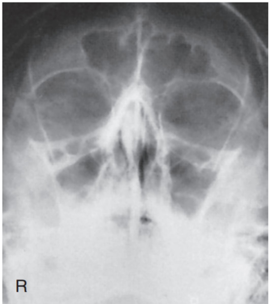 <p>-Position: No rotation of the cranium is indicated by the following: equal distance from MSP (identified by the bony nasal septum) to lateral orbital margin on both sides; equal distance from the lateral orbital margin to the lateral cortex of the cranium on both sides. </p><p>• Adequate extension of neck demonstrates petrous ridges just inferior to the maxillary sinuses</p>