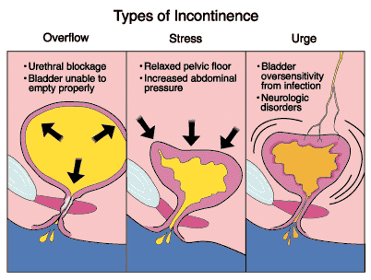 <p>______ is the inability to control one's bladder or bowel movements.</p>