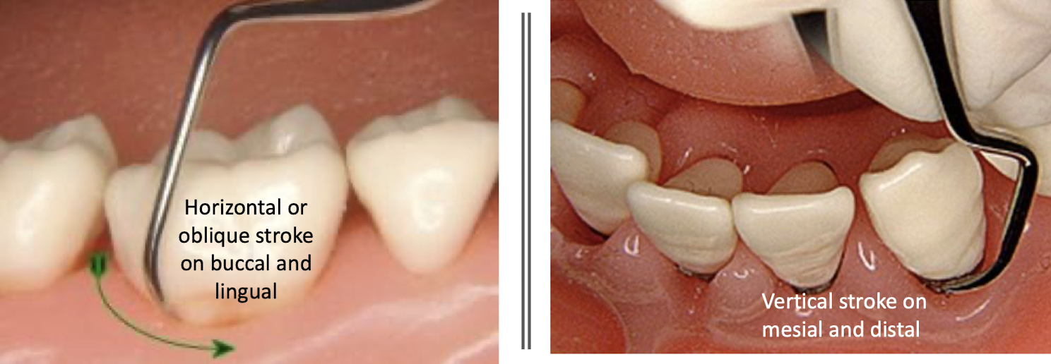 <ul><li><p>face of working end is at 90 degrees to lower shank </p></li><li><p>blade slightly rotated toward tooth and is slightly closed </p></li><li><p>B/L stroke: horizontal/oblique stroke </p></li><li><p>M/D surfaces: vertical stroke </p></li></ul><p></p>
