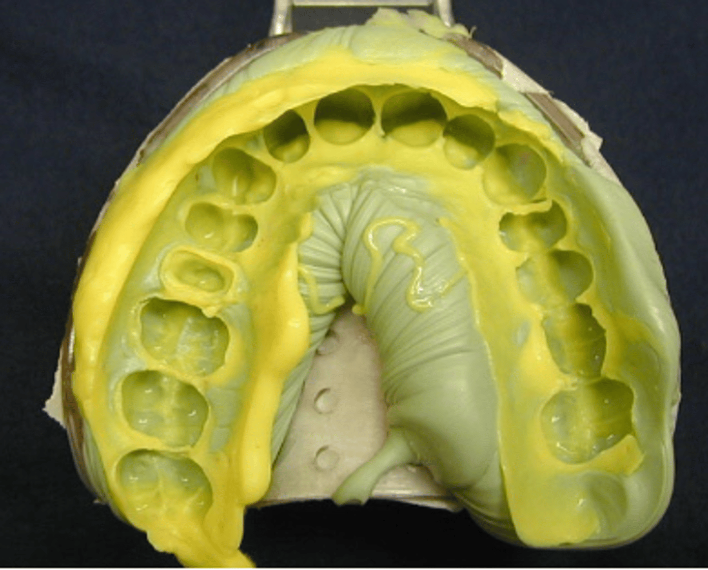 <p>What type of impression material?</p>