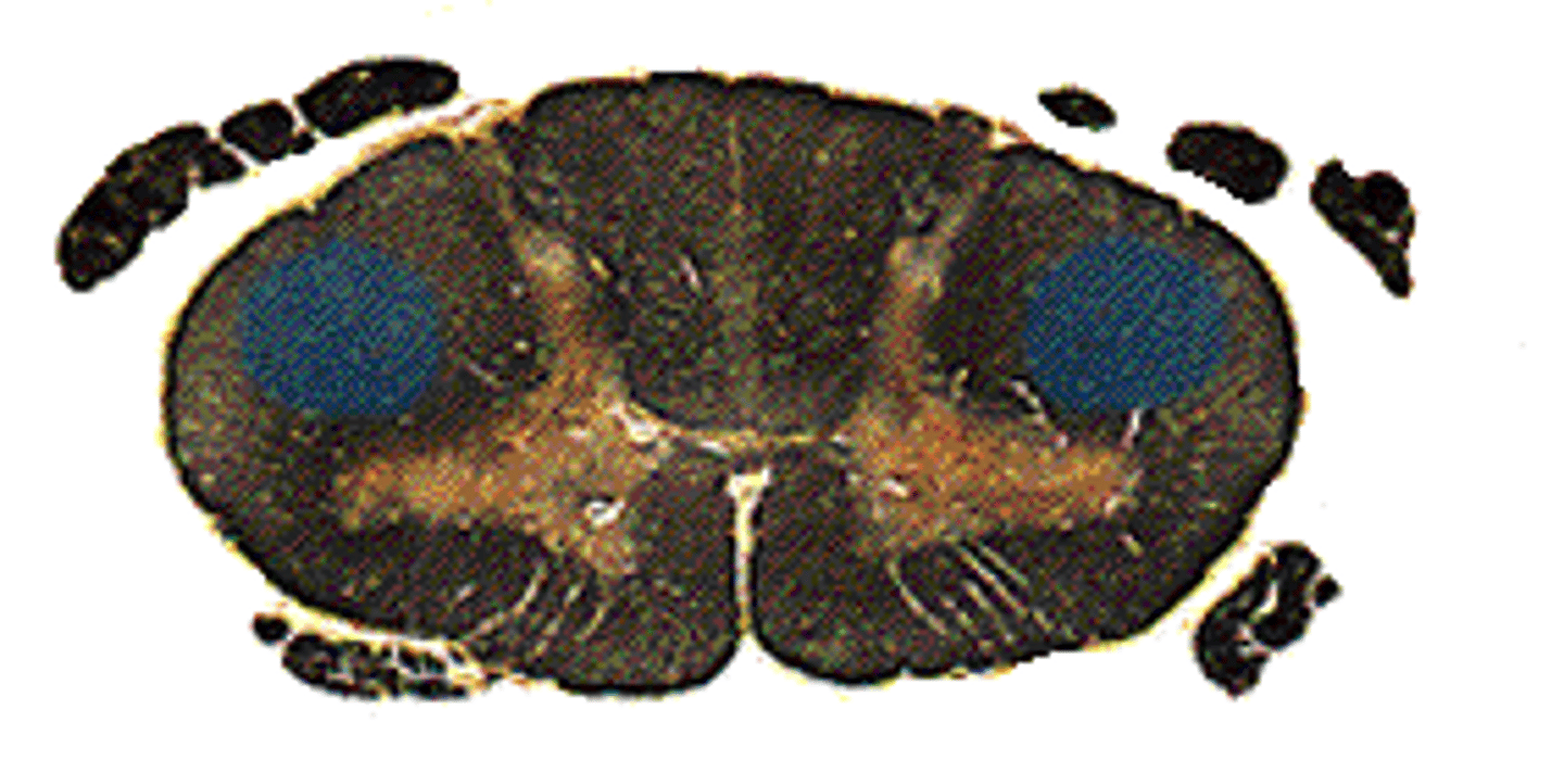 <p>-a set of axons from the primary motor cortex, surrounding areas, and midbrain area that is primarily responsible for controlling the peripheral muscles</p><p>-controls contralateral muscles</p><p>-innervates motor neurons (excitation) in ventral horn and interneurons (inhibition)</p>