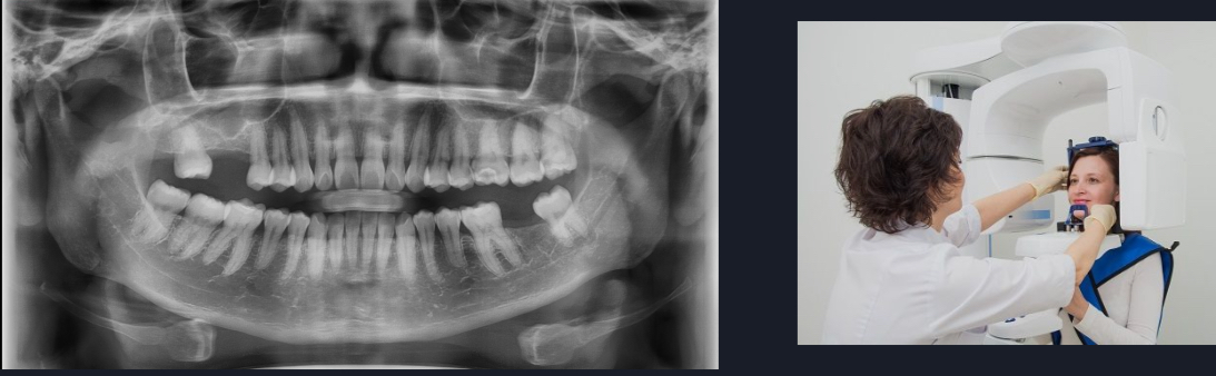 <p>Panoramic X-rays </p>