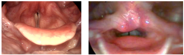 <ul><li><p>Muscle tension can occur as either a primary or secondary phenomenon.</p></li><li><p>E.g., can occur on its own, or someone may develop a muscle tension dysphonia to compensate for laryngitis, nodules, etc. Often the pattern of tense voicing becomes learned, and even once the primary cause (e.g. laryngitis) has gone, the individual continues to voice in this way.</p></li><li><p>It is characterised by excessive squeezing, tension or compression on the cartilages and soft tissues within and directly surrounding the larynx.</p></li></ul><p>Common patterns include:</p><p>1. Anterior-posterior (AP) compression (top and bottom)&nbsp;</p><p>2. Phonation with (or squeeze of) the false (ventricular) vocal cords- ‘plicae ventricularis’</p><p>3. Hyper-adducted arytenoids, causing posterior gap</p><p></p>
