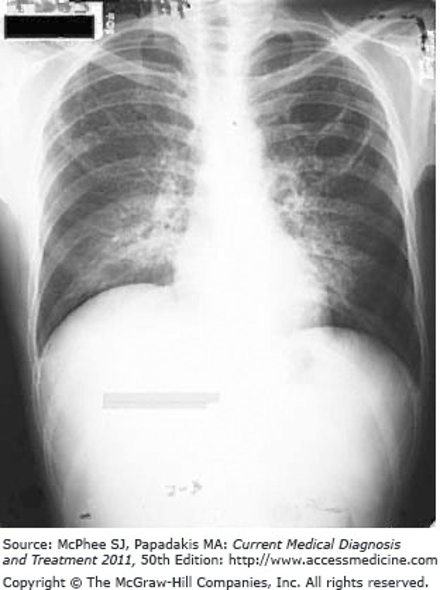 <p>The Correct Answer is: A</p><p>For a confirmed bacteria or suspected case of pneumonia caused by Pneumocystosis jiroveci, TMP-SMX is the antibiotic of choice for this patient.</p>
