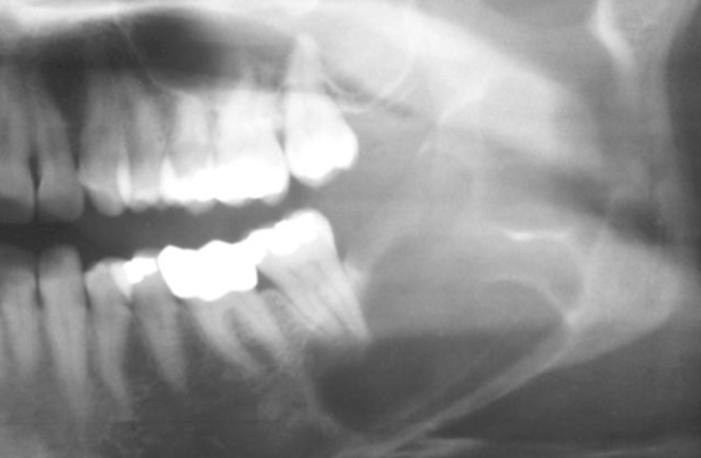 <p>Mandibular posterior area</p>