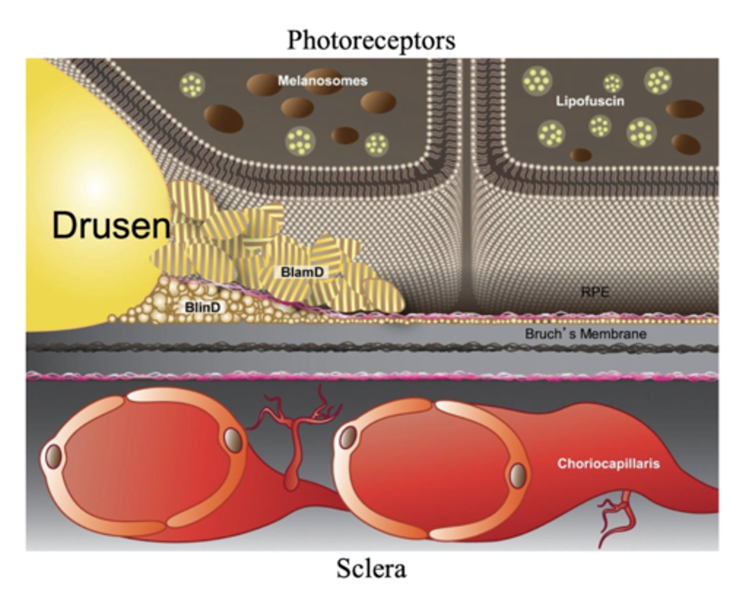 <p>cholesterol accumulation leads to panmacular deposits between Bruch's membrane and the RPE, eventually become clinically visible drusen, impairs normal transport (like chromophore) across Bruch's membrane</p><p>causes localized deficiency of vitamin A, and dark adaptation</p>