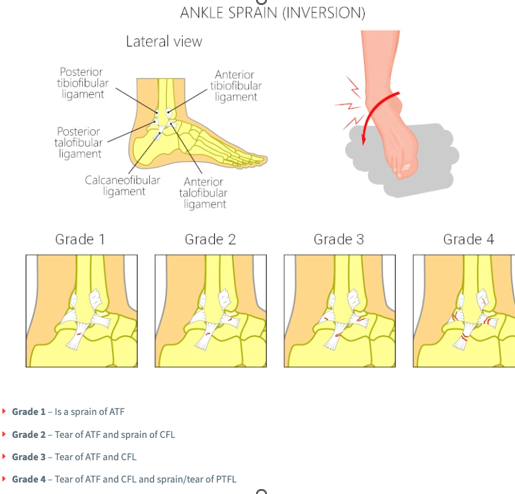 <p><span>-MOI: twist the foot upwards and the ankle rolls inward</span></p><p><span>-ATFL, PTFL, CFL</span></p><p></p>