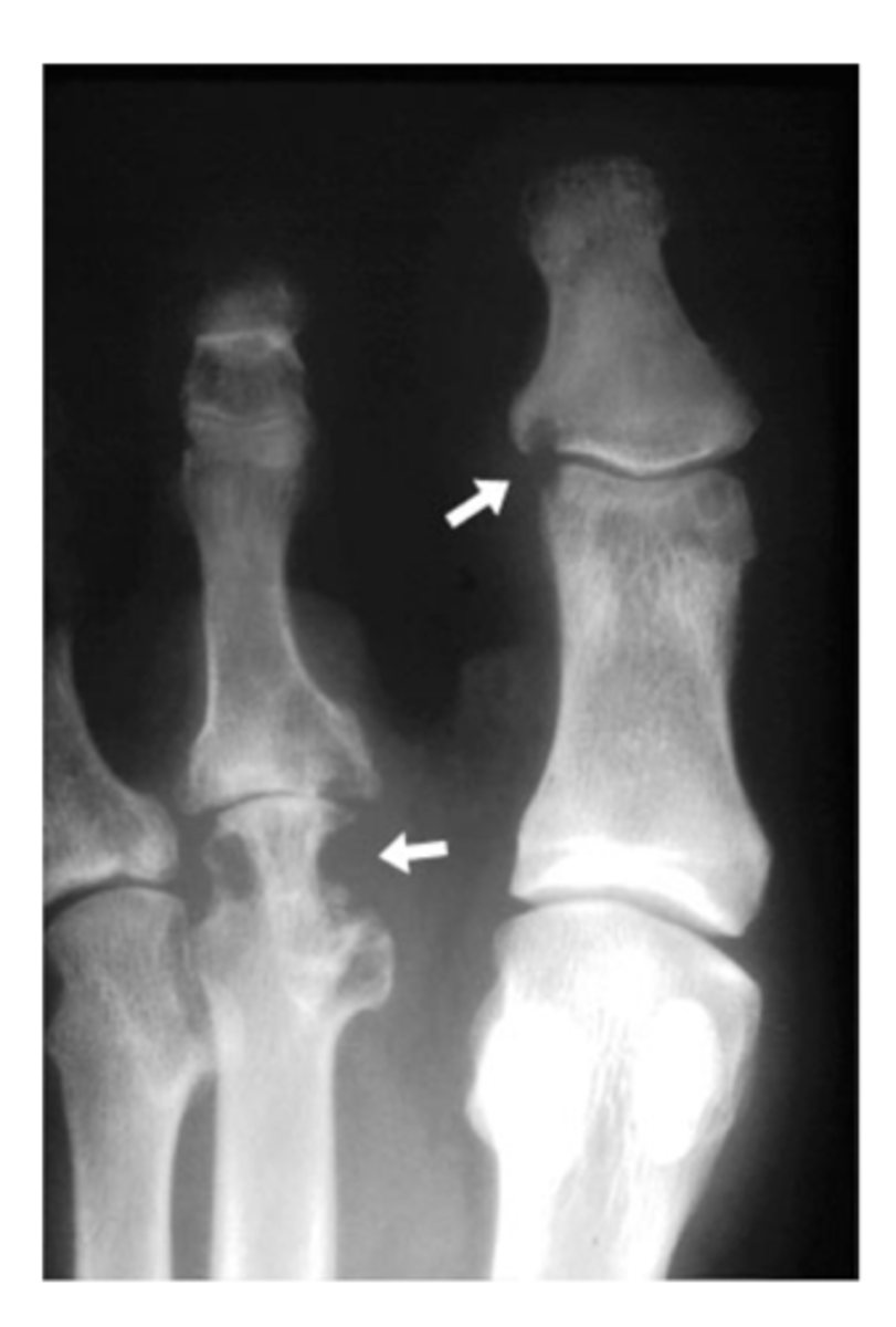 <p>Scalloped, notched edges that indicate cartilage damage and wearing away of bone -- think rheumatic diseases (RA, PA, etc.)</p>