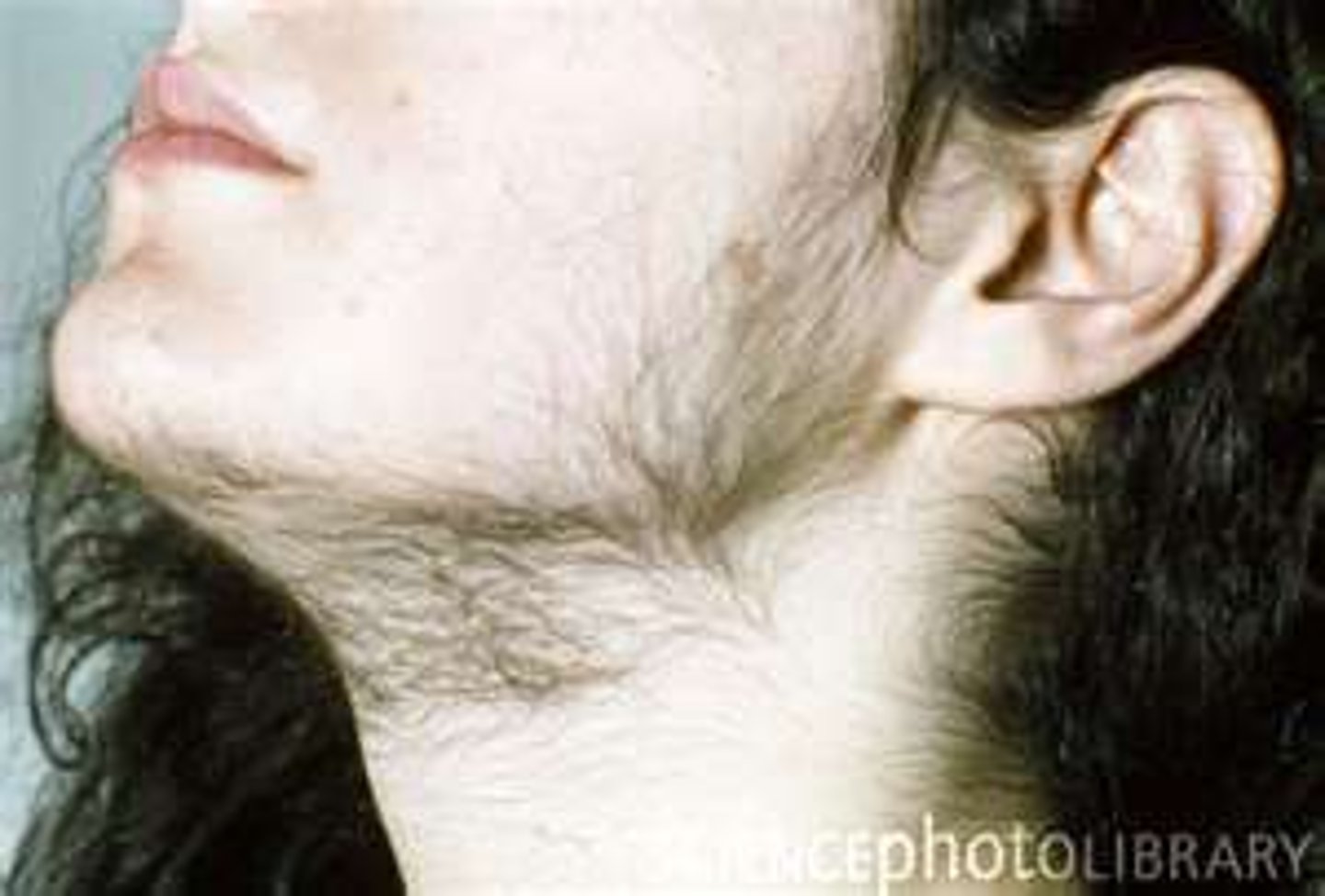 <p>Condition pertaining to an excessive growth or cover of hair, especially in women. in unusual locations</p>