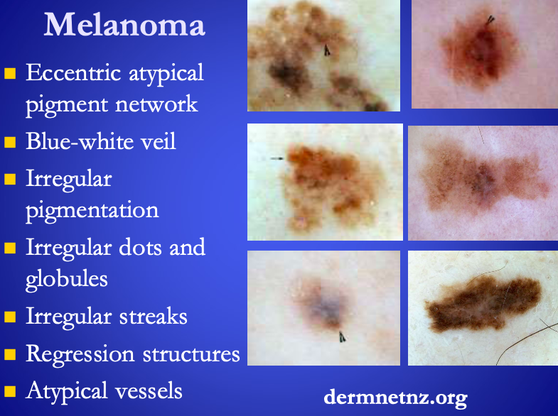 <p><span><strong>[Benign or melanoma?]</strong></span></p><ul><li><p>Homogenous</p></li><li><p>Parallel pattern</p></li><li><p>Pigmented network</p></li><li><p>Cobblestone pattern</p></li><li><p>Pigmented globules</p></li><li><p>Starburst pattern&nbsp;</p></li></ul><p></p>