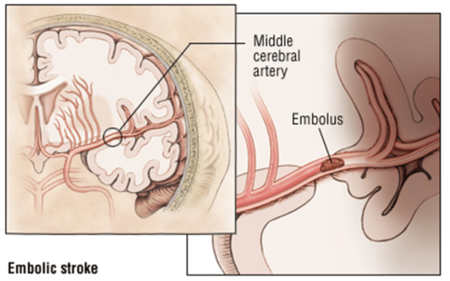 <p>Ischemic stroke due to embolus<br>(AKA -&gt; hemorrhagic stroke)</p>