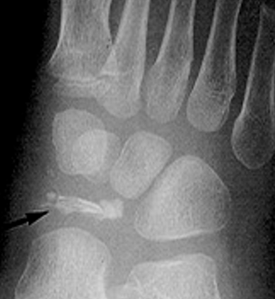 <ul><li><p>patchy and/or homogenic sclerosis (increased density)</p></li><li><p>severe cases bone collapses and fragments</p></li><li><p>abnormal architecture evident into adulthood</p></li></ul><p></p>