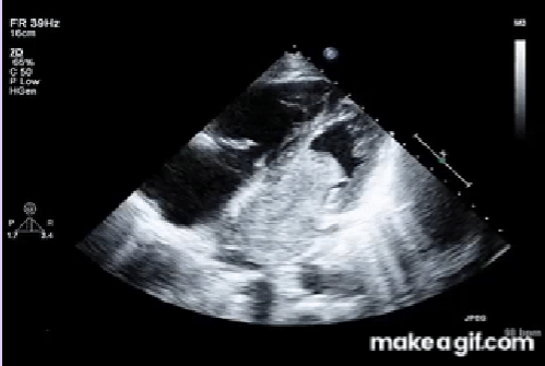 <p>Most common adult primary benign tumor.</p><p>75% occur in the right atrium.</p><p>Most often arise from the fossa ovalis.</p><p>Mobile, lobular mass.</p>