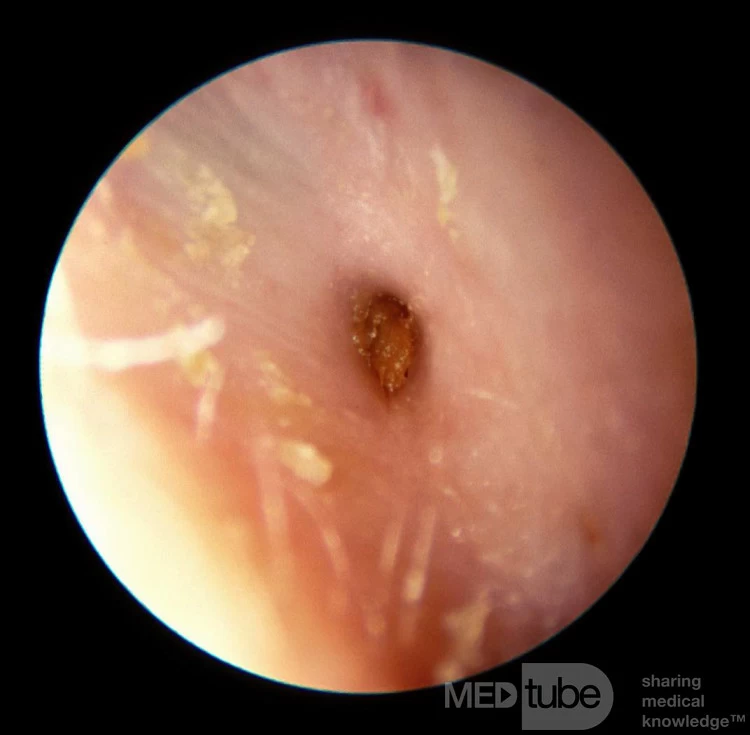 <p>narrowing of the external auditory canal</p><p>age, or may be congenital</p><p>Treatment: possible surgery if there is hearing loss</p>