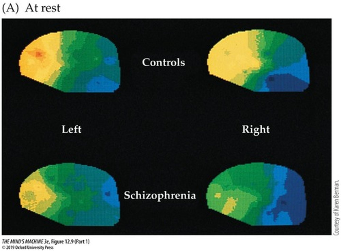 <p>the idea that schizophrenia may reflect underactivation of the frontal lobes</p>