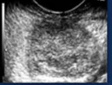 <p>Echogenicity of this </p>