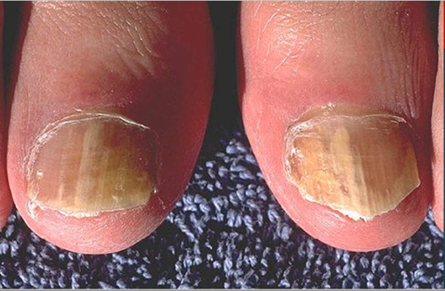 <p>Tinea unguis (aka onychomycosis)</p><p>Caused by Trichophyton rubrum [anthropophilic fungi]</p>