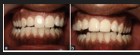 <ul><li><p>canine-protected occlusion or organic occlusion </p></li></ul><p></p>