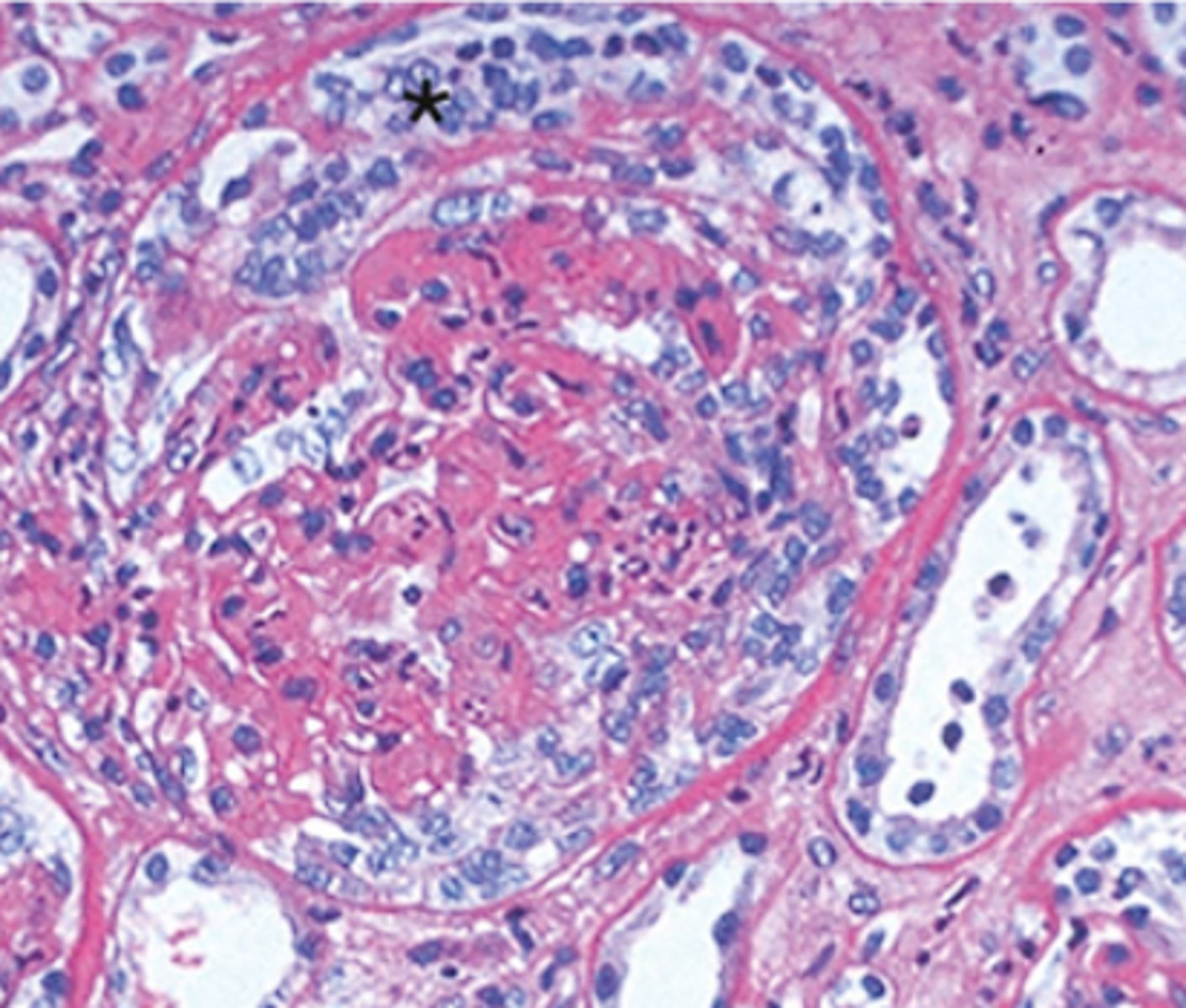 <p>-main feature is the formation of crescents</p><p>-severe glomerular injury: segmental capillary necrosis, breaks in the basement membrane (visible on EM)</p><p>-deposition of fibrin in Bowman's space</p>