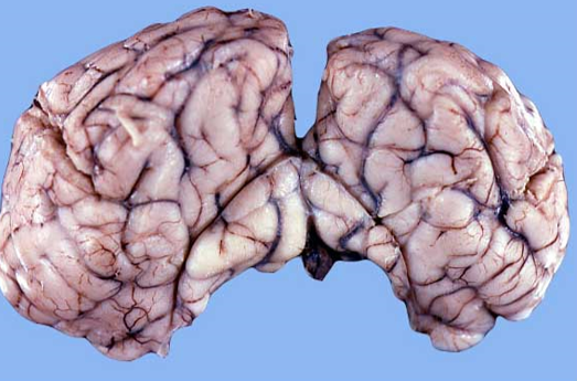 <p>8.<span>&nbsp; </span>Tissue from a dog.<span>&nbsp;&nbsp; </span>This slide represents brain herniation under the ______?</p><ol type="a"><li><p>Falx cerebri</p></li><li><p>Tentorium cerebelli</p></li><li><p>Sella vermis</p></li><li><p>Foramen magnum</p></li></ol><p></p>
