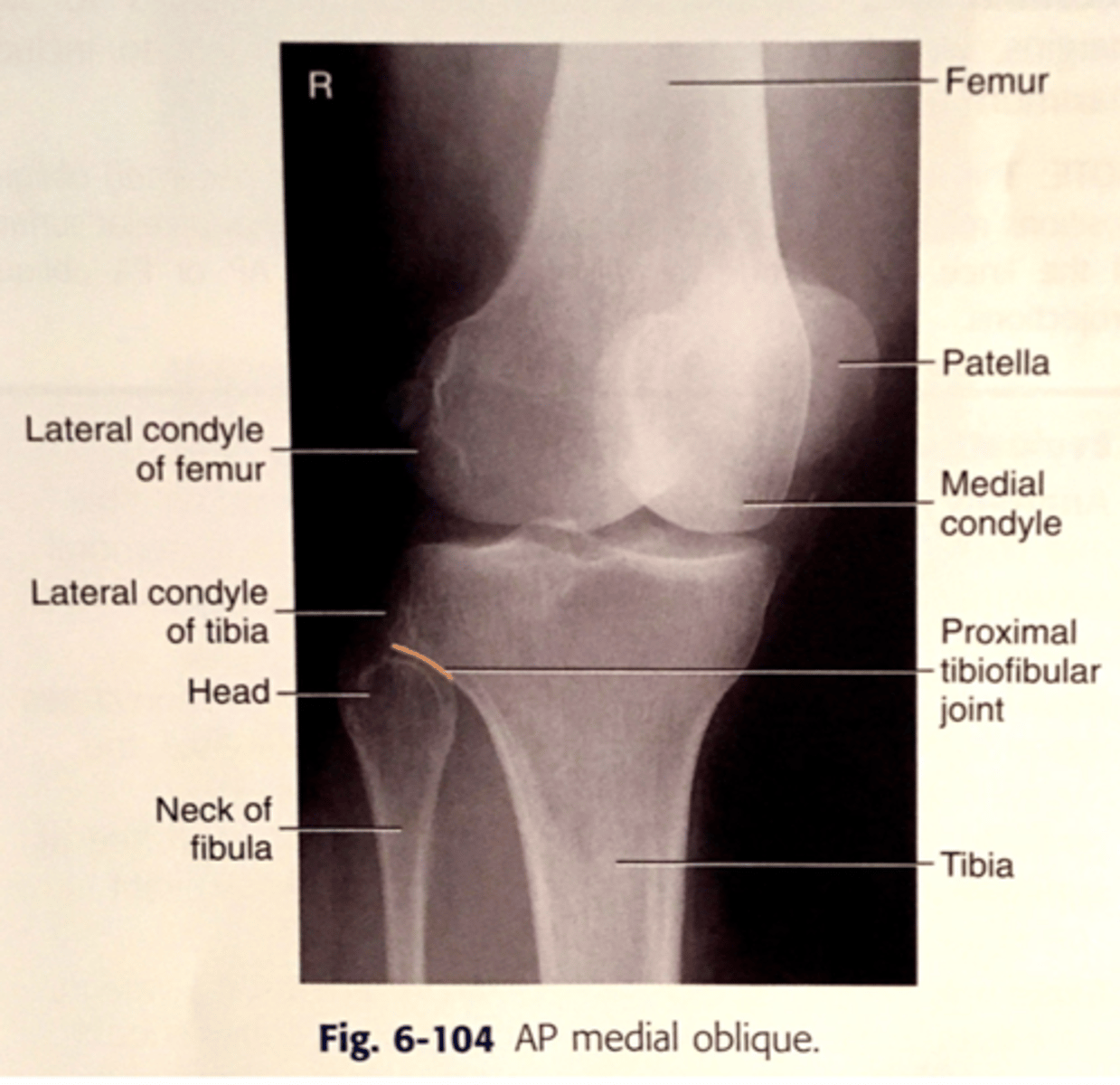 <p>distal femur and proximal tibia/fibula</p><p>patella superimposing the medial femoral condyle</p><p>lateral condyles of the femur and tibia</p><p>medial and lateral knee joint spaces appear unequal</p>