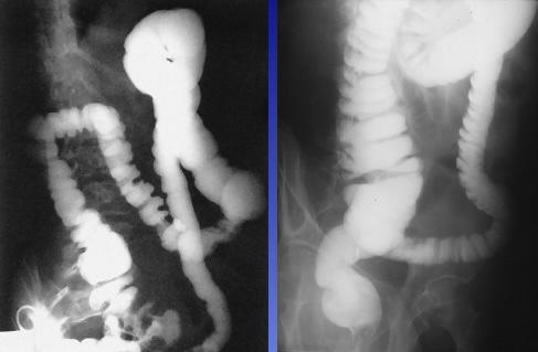 <p>What is this x-ray demonstrating?</p>