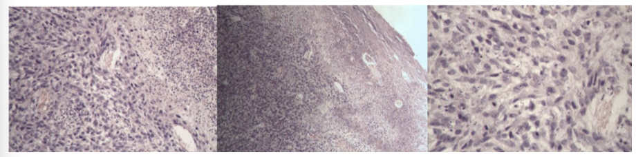 <p><strong>fibrosarcomna uteri </strong></p>