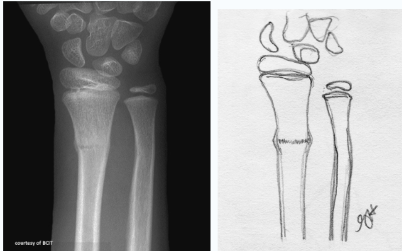 <p>what fracture type is this</p>