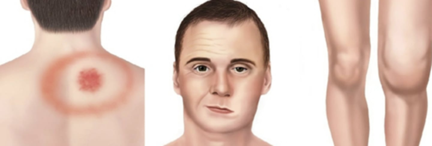 <p>Lyme</p><p>Ticks</p><p>erythema</p>