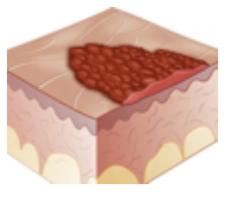 <p>Secondary Skin Lesion</p><ul><li><p><strong>Dried serum/blood</strong></p></li><li><p><strong>Ruptured</strong> fluid filled lesion</p></li><li><p>E.g., ruptured vesicles of herpes simplex</p></li></ul><p></p>