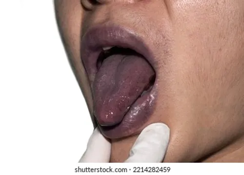 <p>Poor perfussion, deficient oxygenation of blood</p>