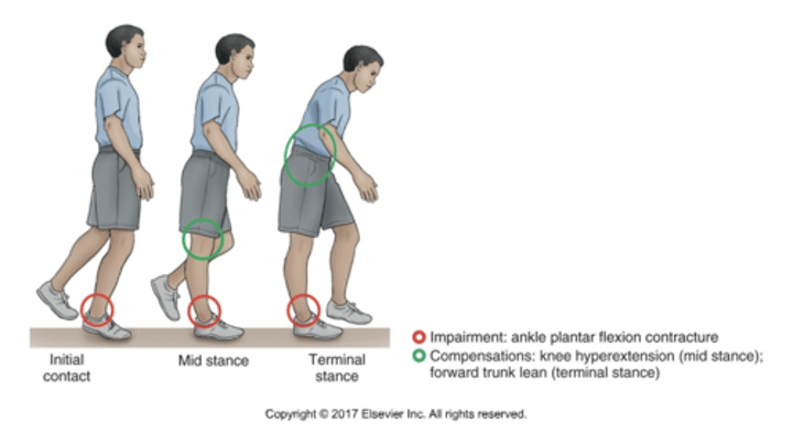 <p>•Knee Hyperextension and Forward Trunk Lean to Compensate for an Ankle Plantar Flexion Contracture (Pes Equinus Deformity)</p>