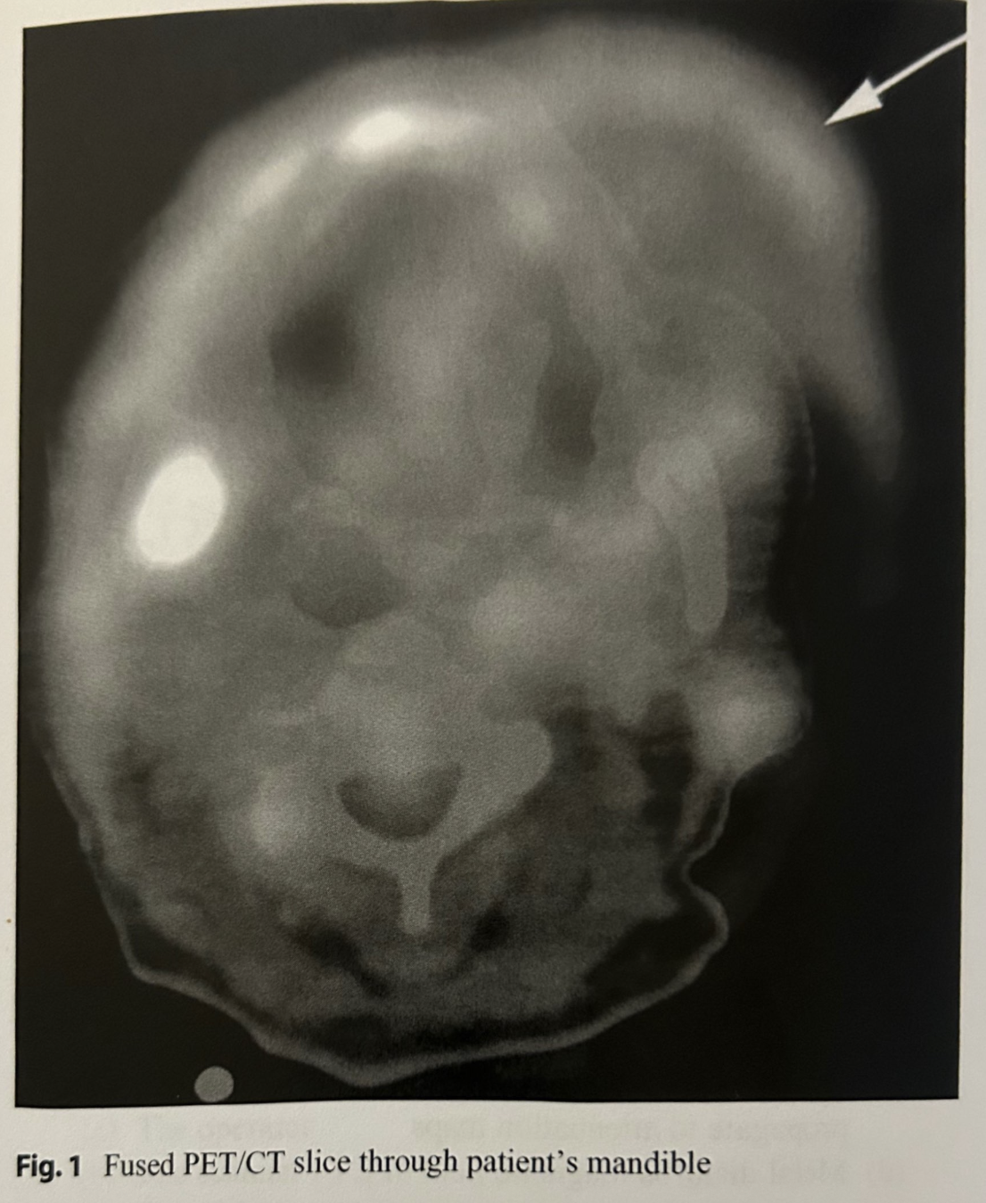 <p>Refer to Fig. 1. In this fused PET/CT transaxial slice through the mandible, what is the likeliest explanation for the area of activity extending outside the boundary of the CT (see arrow)?</p>