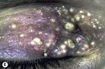 <p>A tiny epidermal cyst that are caused by  occlusions of pilosebaceous units. They appear as white round papules that occur in groups. The treatment is observation. </p>