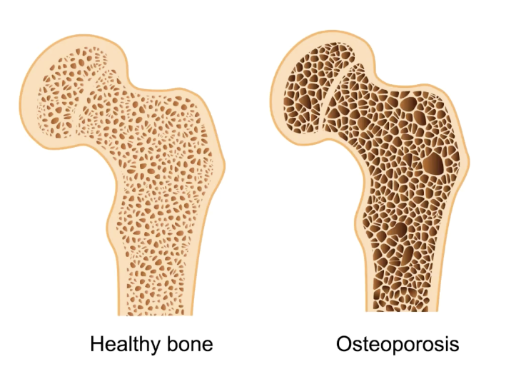 <p>Bone resorption overtakes formation. Decreased bone density</p><p>Most effected bones:</p><ul><li><p>Proximal ends of femur</p></li><li><p>Vertebrae</p></li><li><p>Carpals</p></li></ul><p></p>